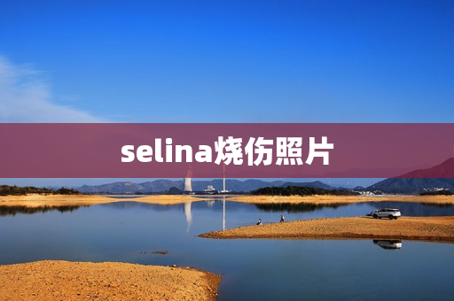 selina烧伤照片